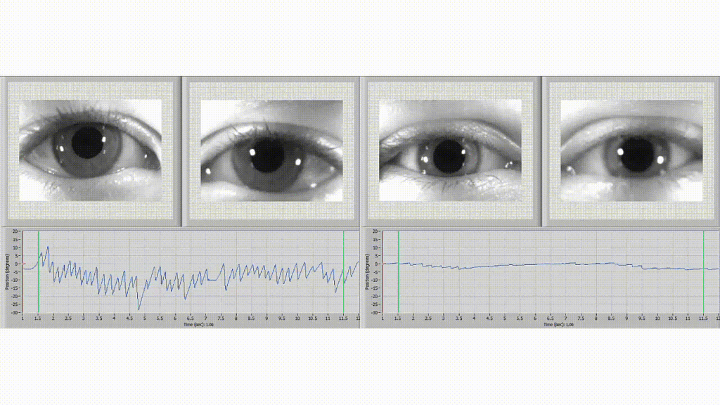 VNG Testing, Vestibular Testing - Concussion, Balance Disorder