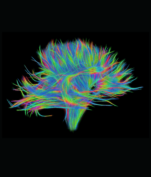 MRI Scan with Diffusion Tensor Imaging (DTI) Testing